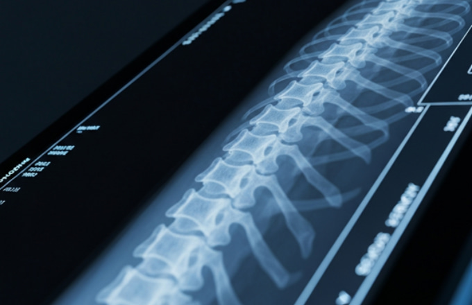 Diagnosing and Monitoring Scoliosis Curve Worsening